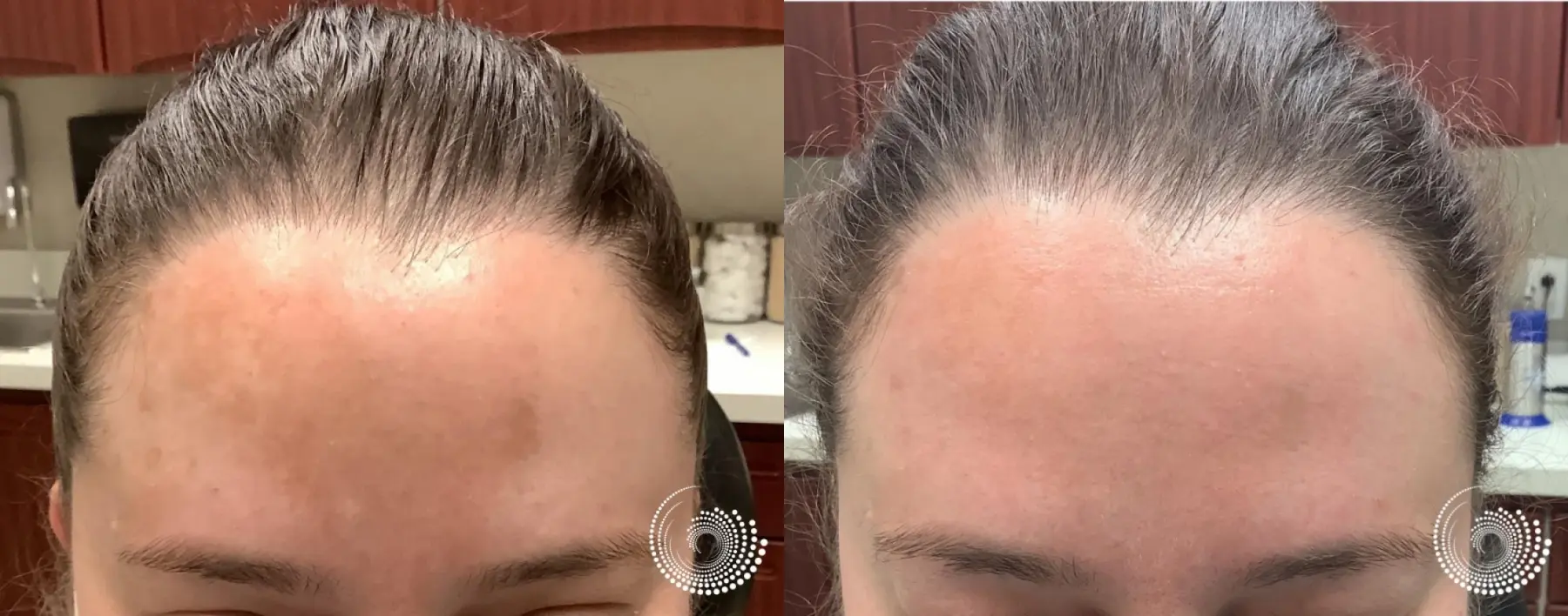 Melasma: Patient 1 - Before and After  