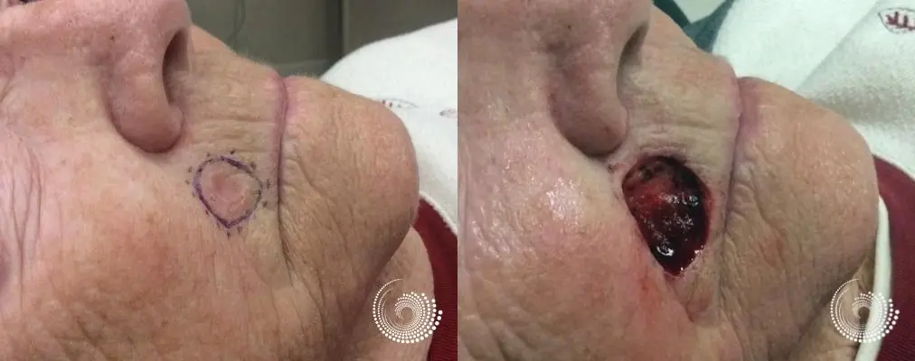 Basal Cell skin cancer above lip Mohs surgery - Before and After 2