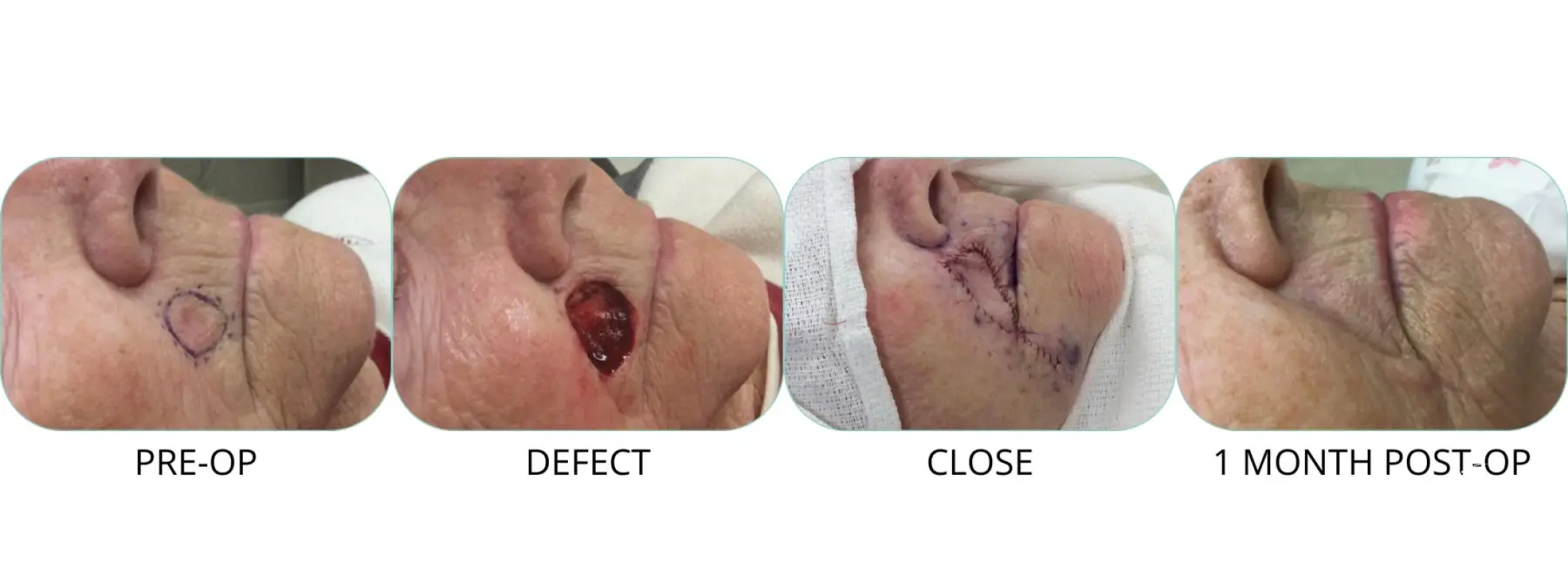 Basal Cell skin cancer above lip Mohs surgery - Before and After 1