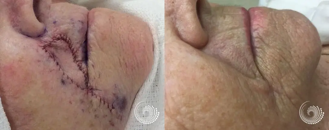 Basal Cell skin cancer above lip Mohs surgery - Before and After 3