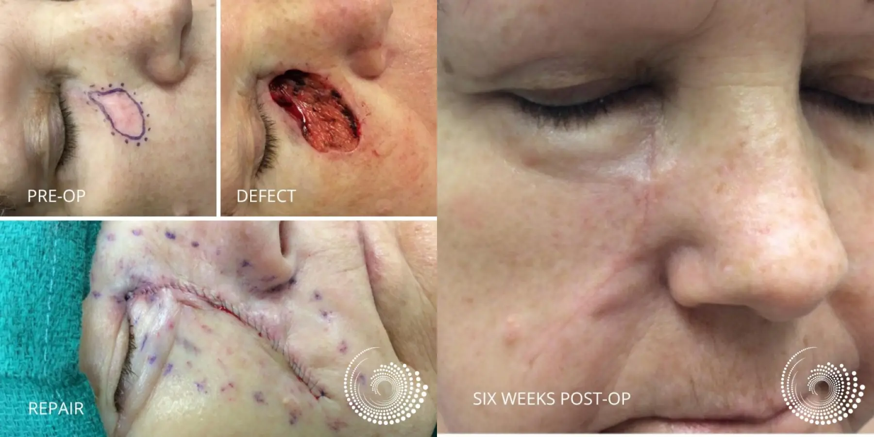 Mohs Surgery for BCC Below Eye - Before and After