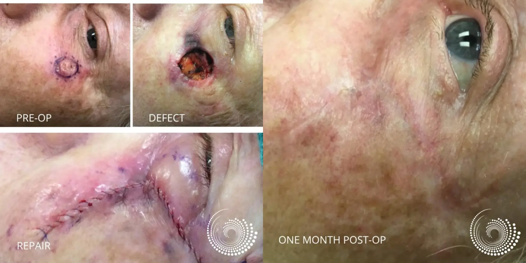 Cheek BCC Treated With Mohs Surgery - Before and After