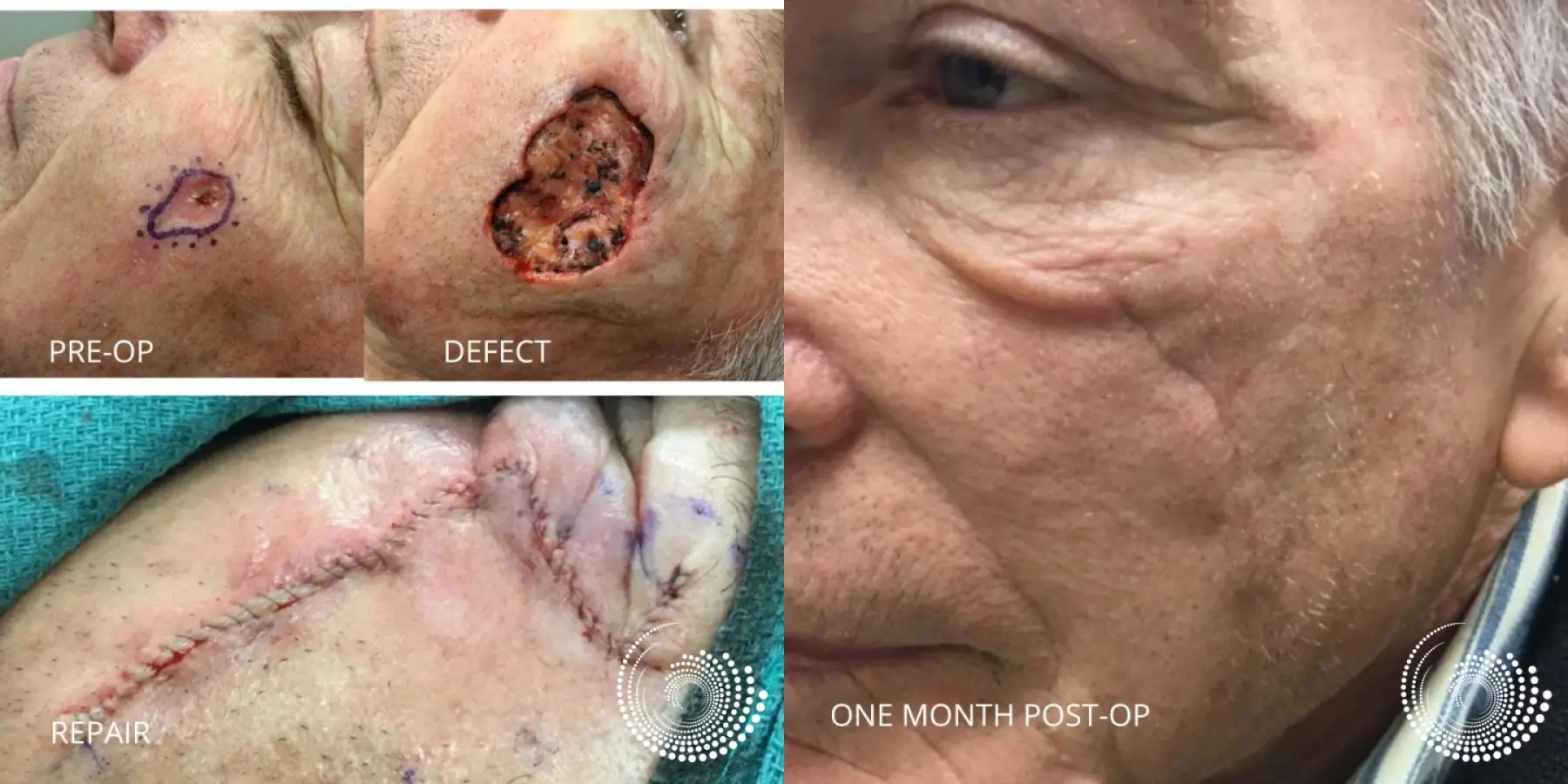Mohs Surgery Clears Cheek BCC - Before and After