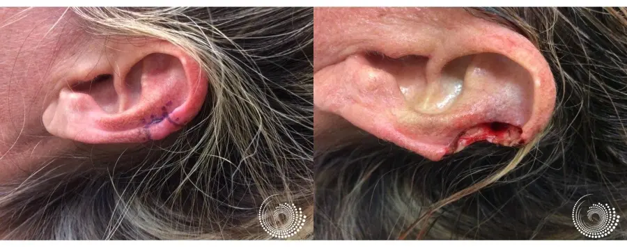 Basal Cell skin cancer, located on the ear - Mohs surgery - Before and After 2
