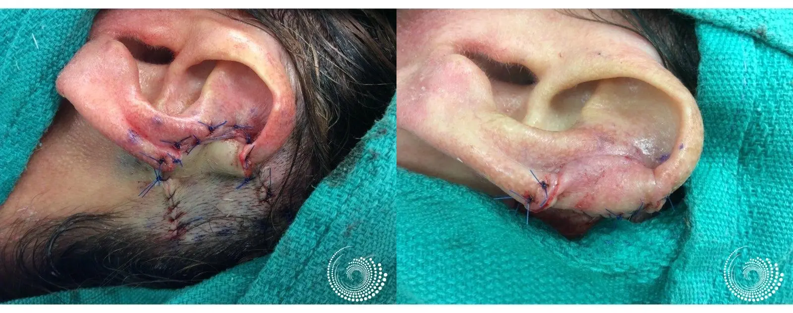 Basal Cell skin cancer, located on the ear - Mohs surgery - Before and After 3