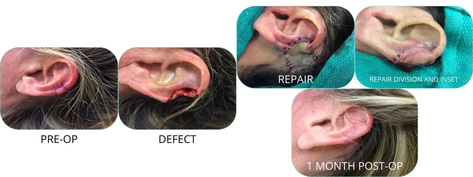 Basal Cell skin cancer, located on the ear - Mohs surgery - Before and After