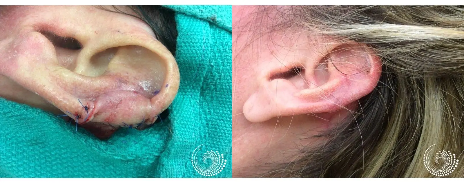Basal Cell skin cancer, located on the ear - Mohs surgery - Before and After 4