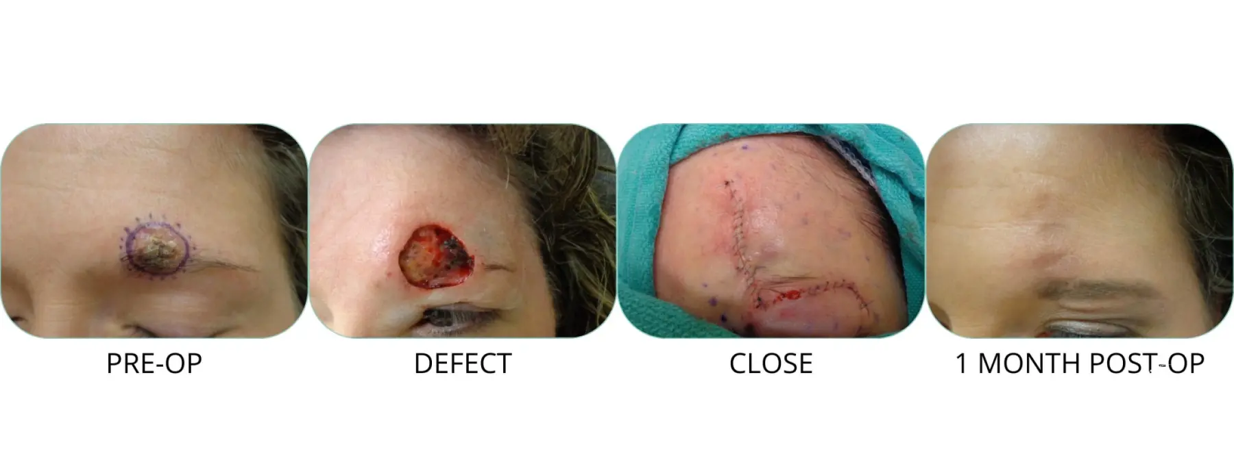 Basal Cell skin cancer, forehead near eyebrow - Mohs surgery - Before and After
