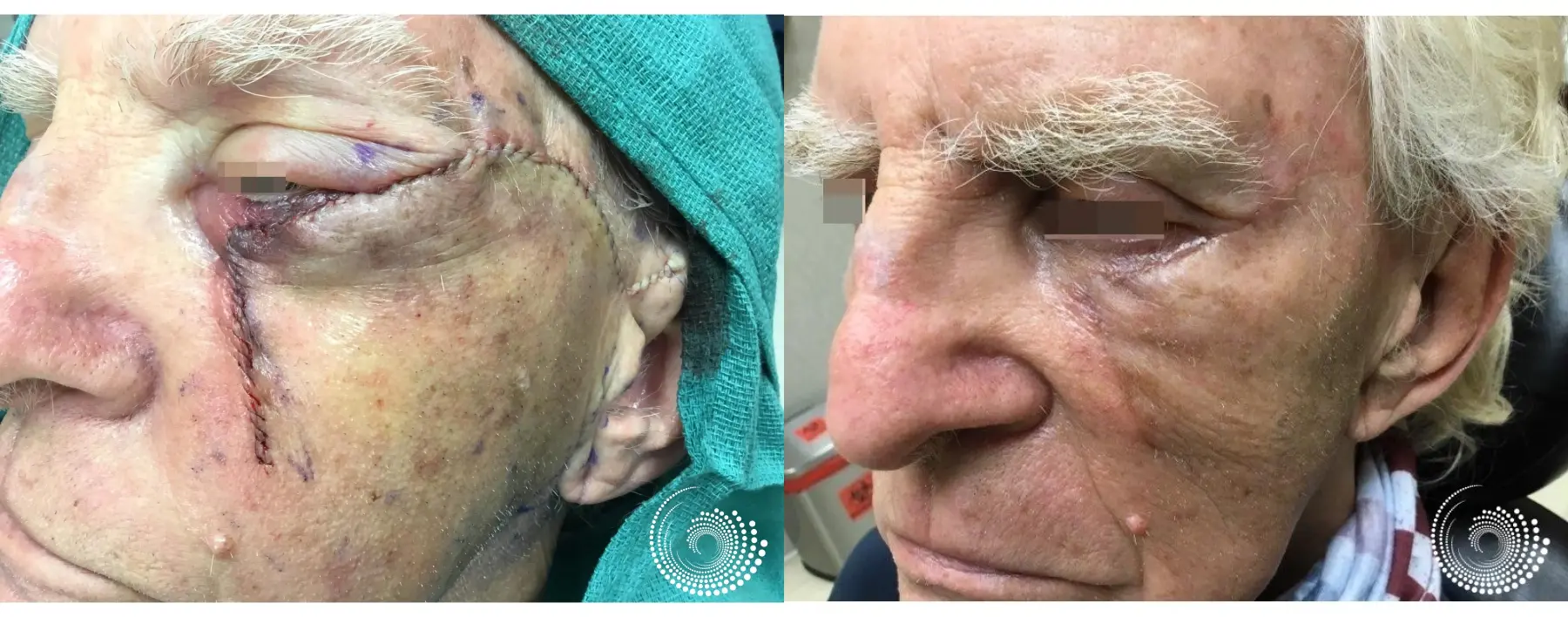 Basal Cell skin cancer under eye Mohs surgery - Before and After 3