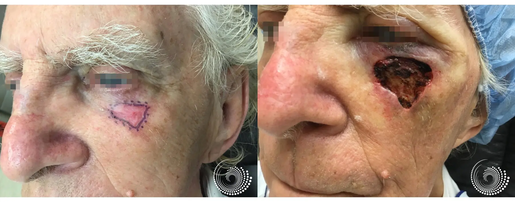 Basal Cell skin cancer under eye Mohs surgery - Before and After 2