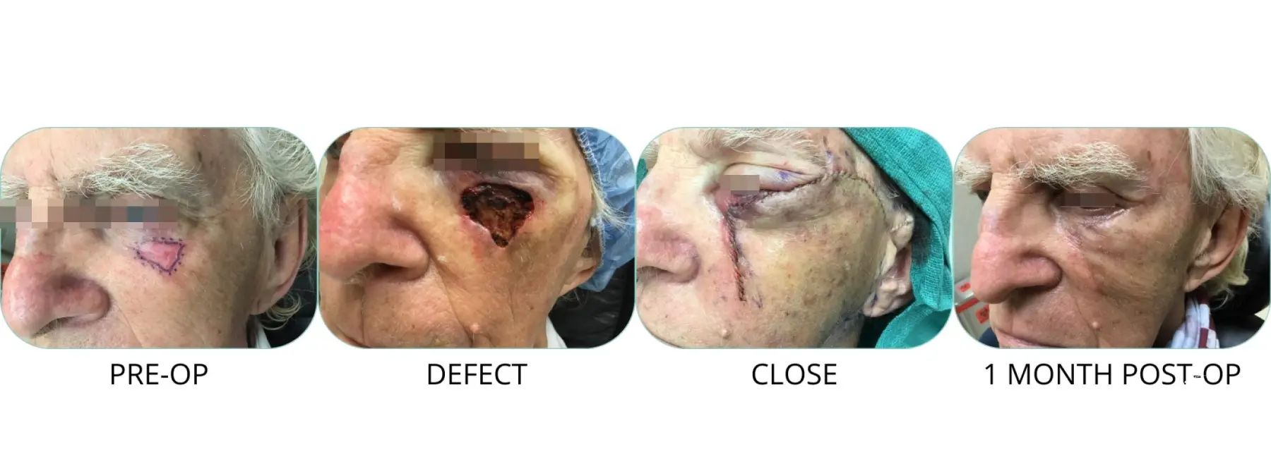 Basal Cell skin cancer under eye Mohs surgery - Before and After 1