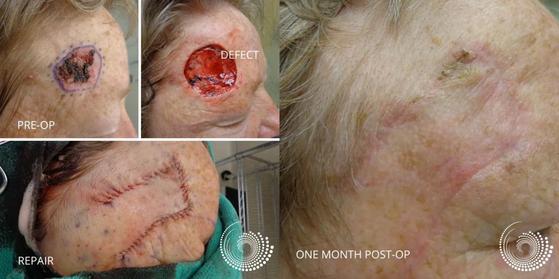 Mohs Clears Large Forehead BCC - Before and After