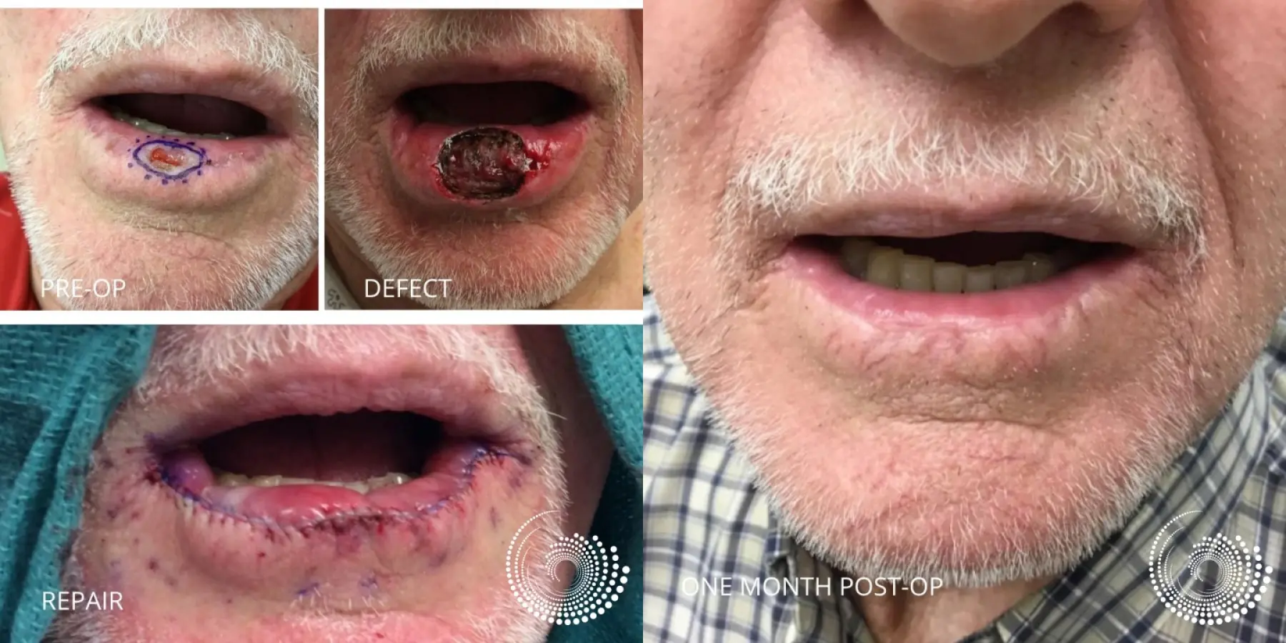 Mohs Surgery Heals Lip Skin Cancer - Before and After