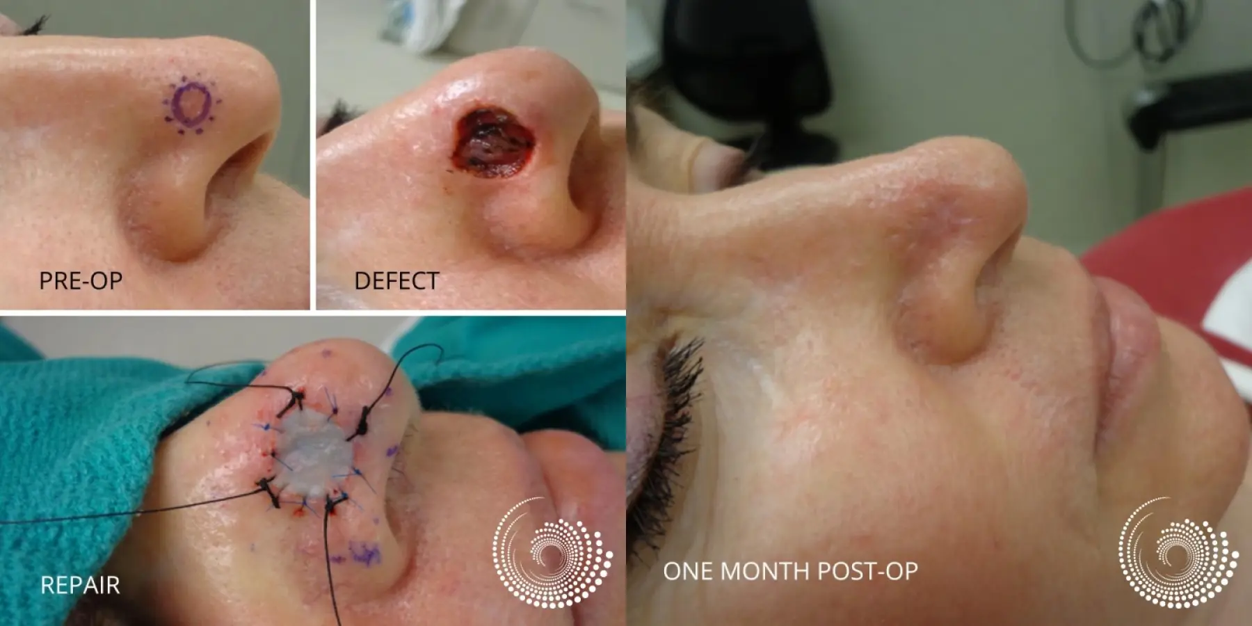 Basal Cell Skin Cancer Nose Mohs Surgery - Before and After