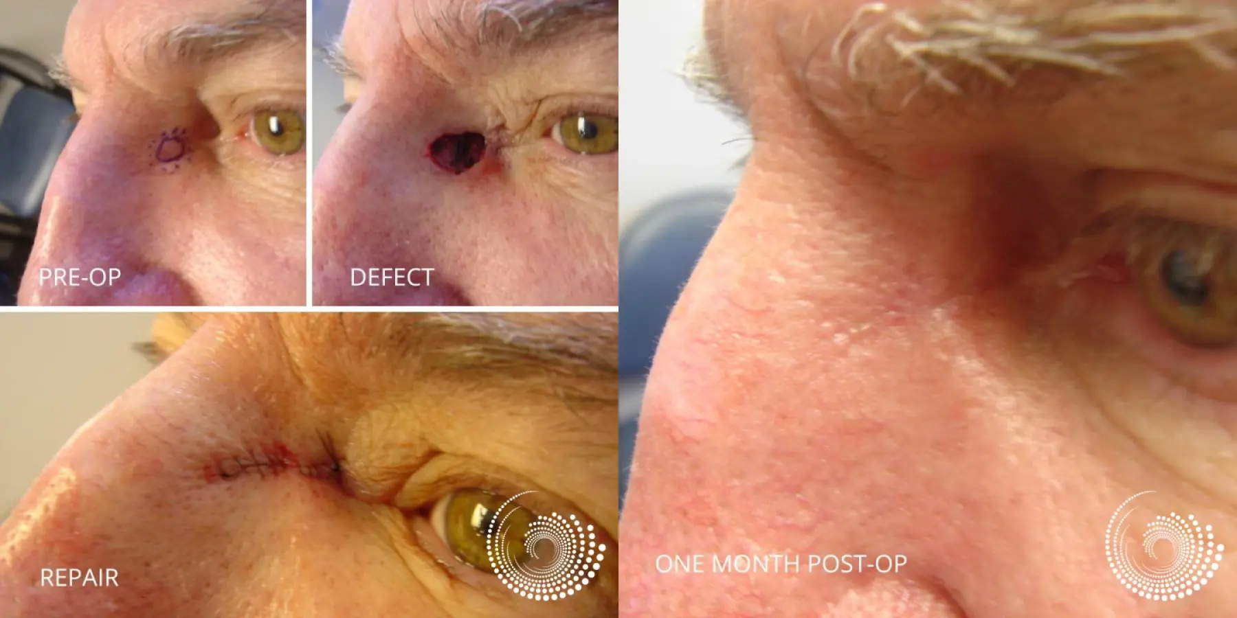 Basal Cell Skin Cancer Nose/Eye area Mohs Surgery - Before and After 1