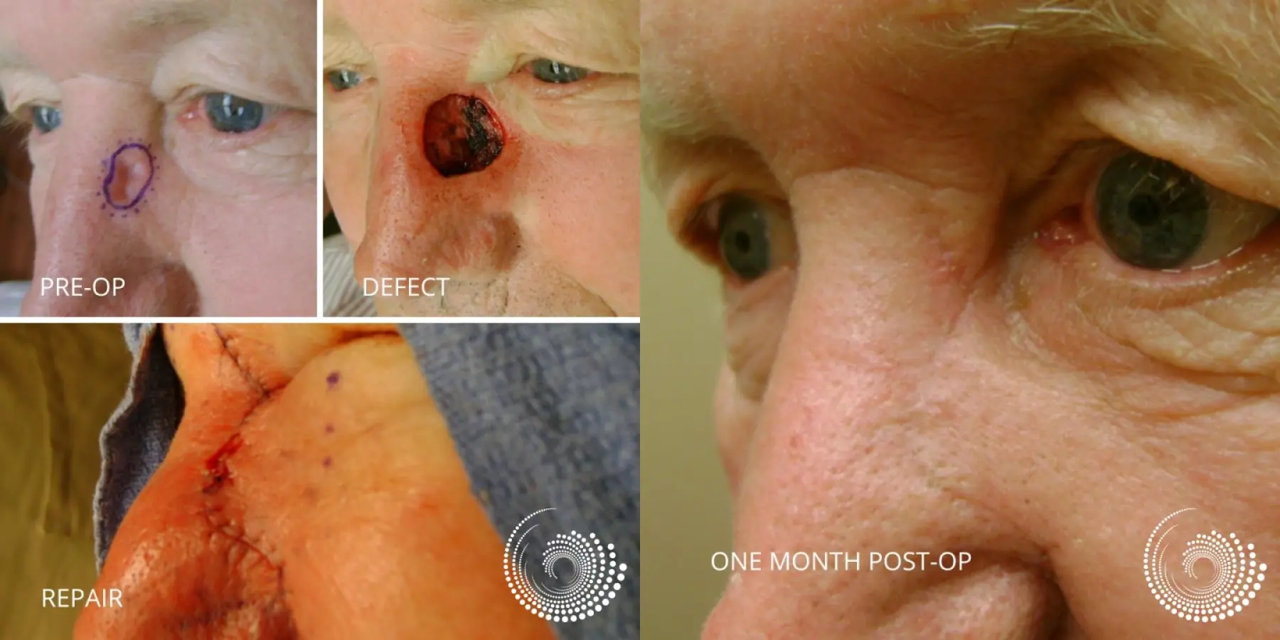 Basal Cell Skin Cancer Side of Nose Mohs surgery - Before and After 1