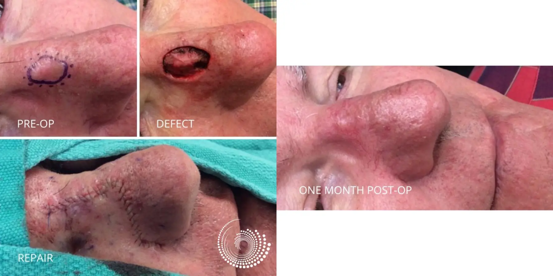 Basal Cell Skin Cancer Nose Septum Mohs Surgery - Before and After