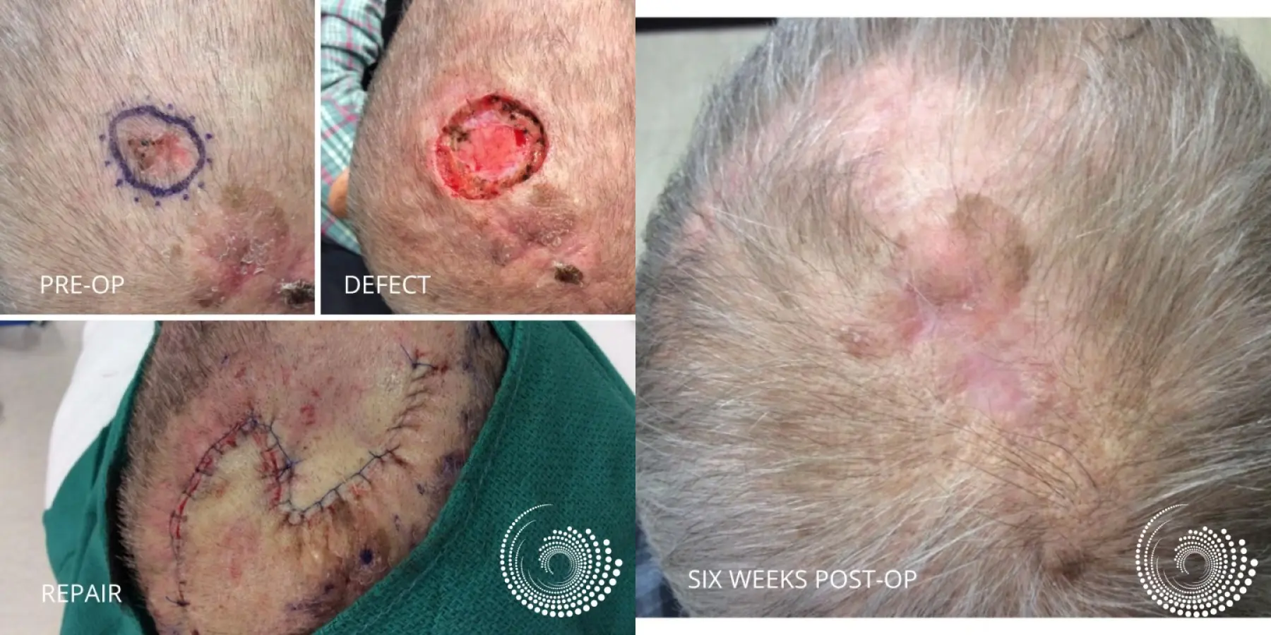 Mohs Surgery for Scalp BCC - Before and After