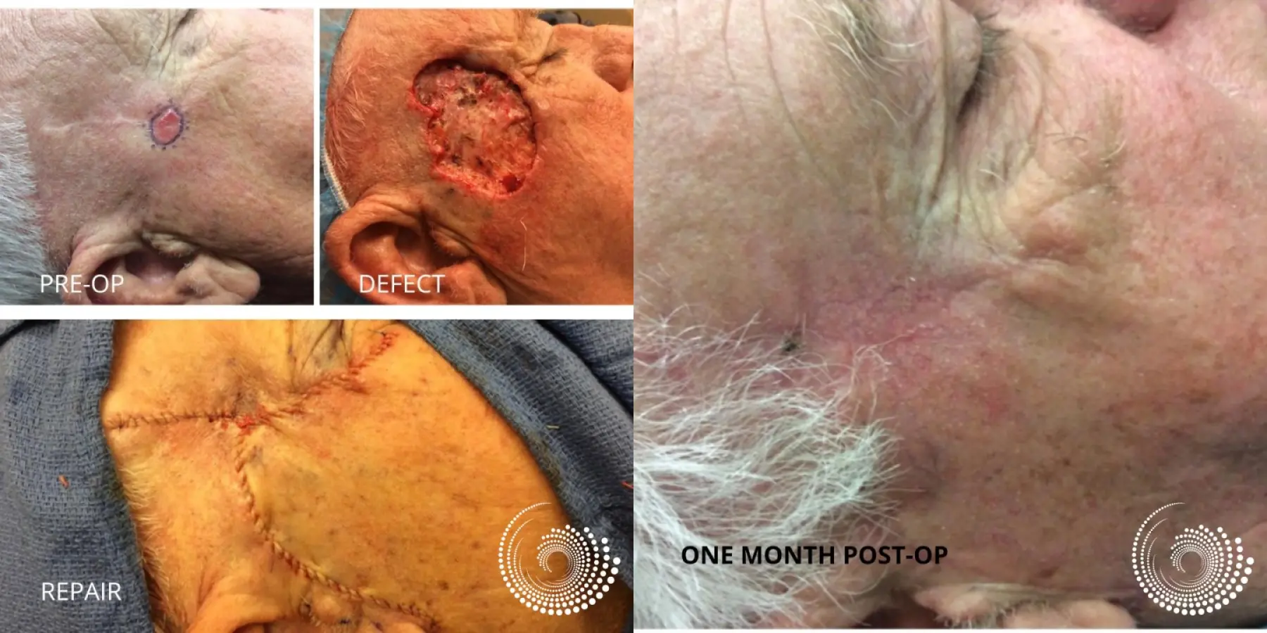 Basal Cell skin cancer Temple Mohs surgery - Before and After
