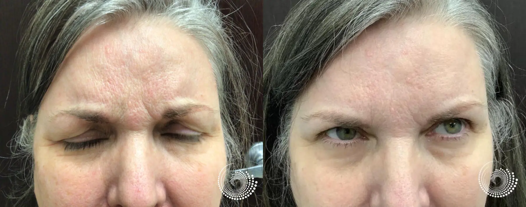 Frown Lines Smoothed—Confidence Restored - Before and After