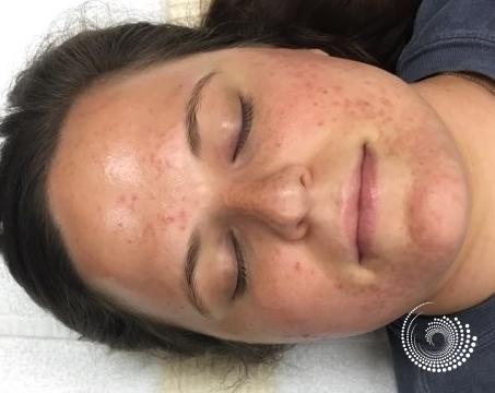 SkinPen Microneedling: Patient 1 - Before 