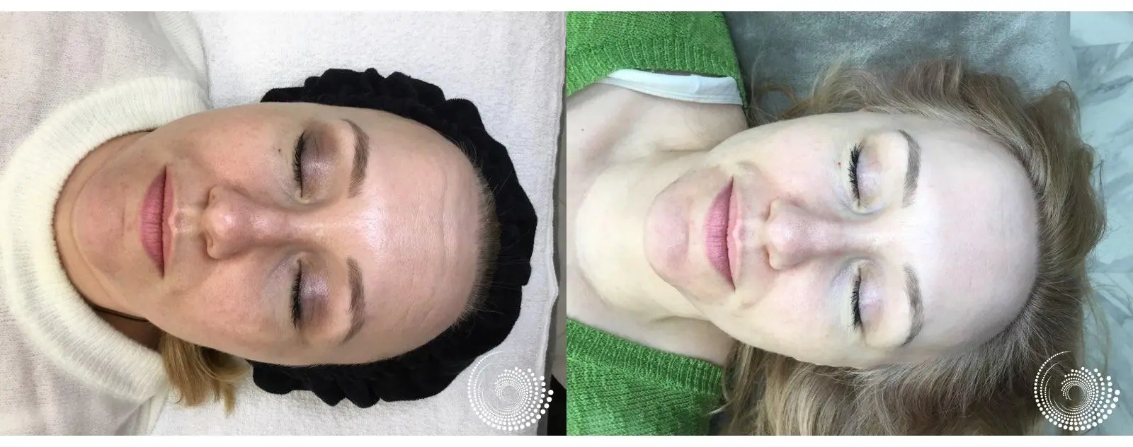 PRP Facial for Glowing Skin Renewal - Before and After