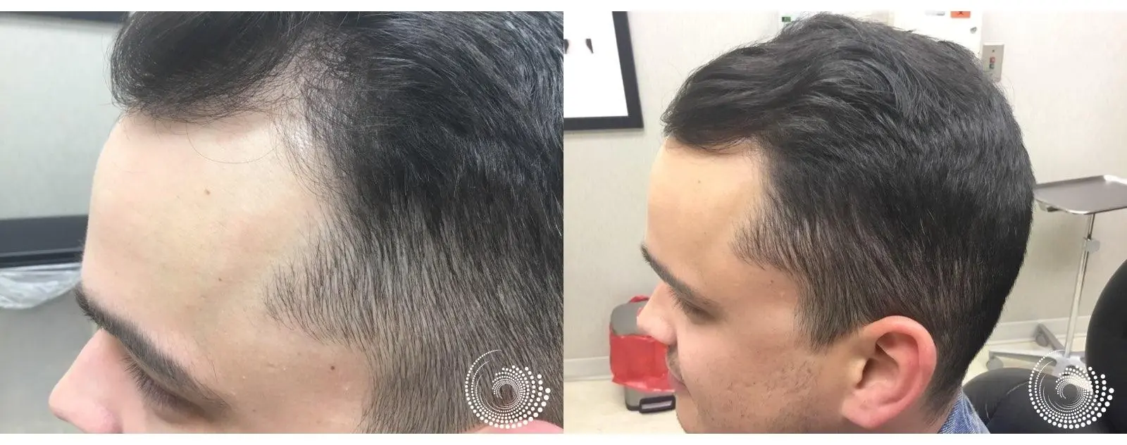PRP Hair Restoration for Thinning Hair - Before and After