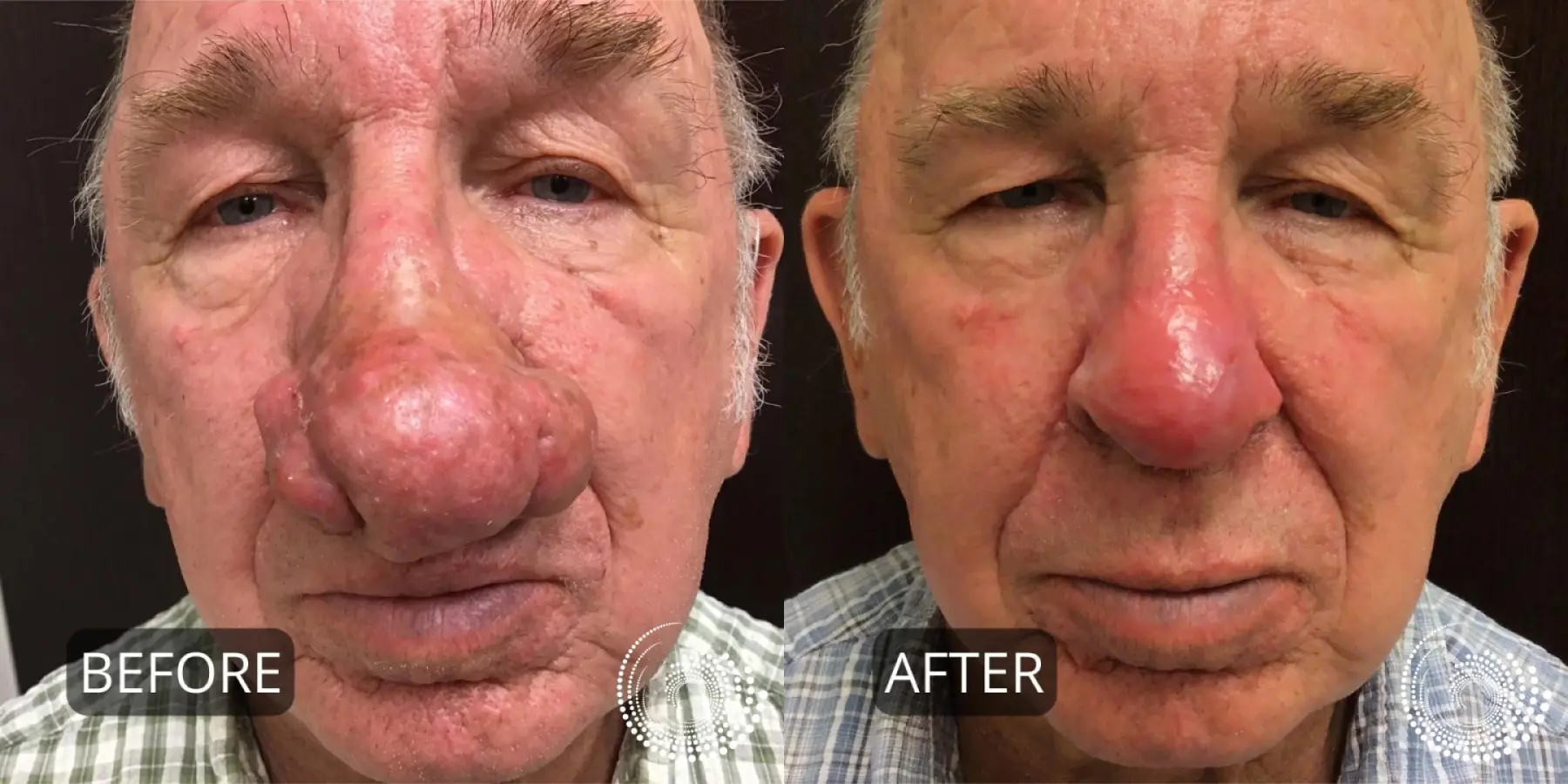 Rhinophyma treatment to reshape nose - Before and After 3