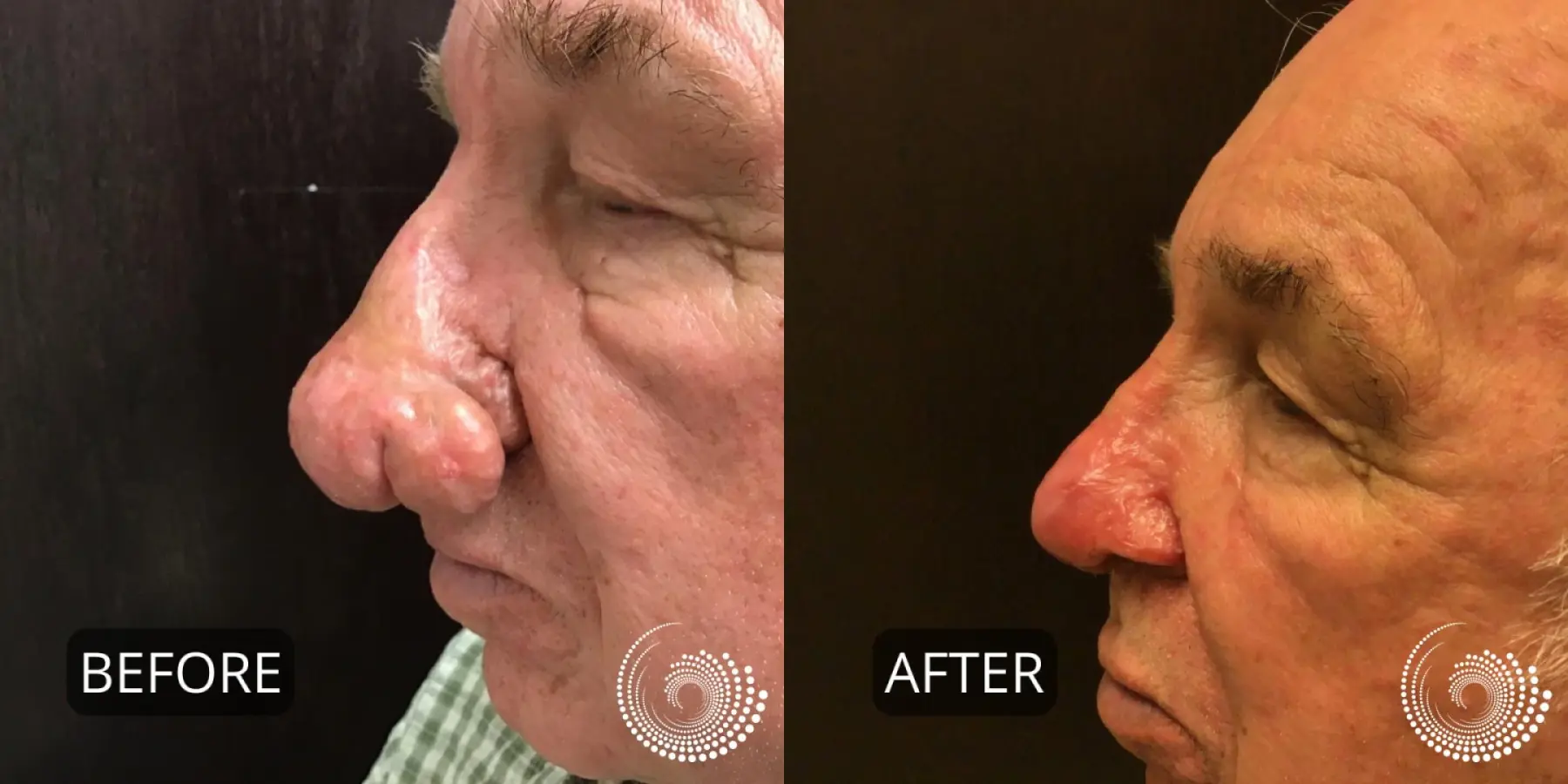 Rhinophyma treatment to reshape nose - Before and After