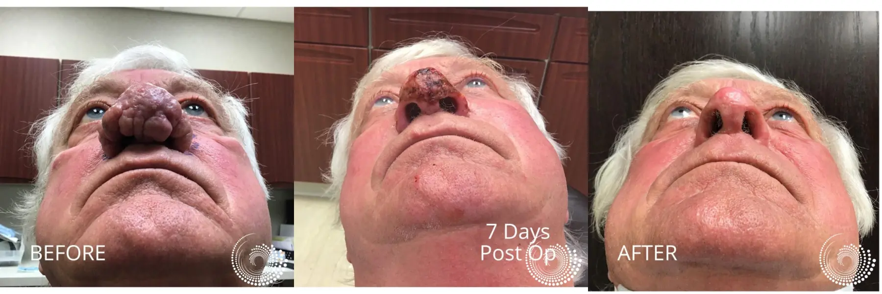 Rhinophyma treatment to restore nose - Before and After 4