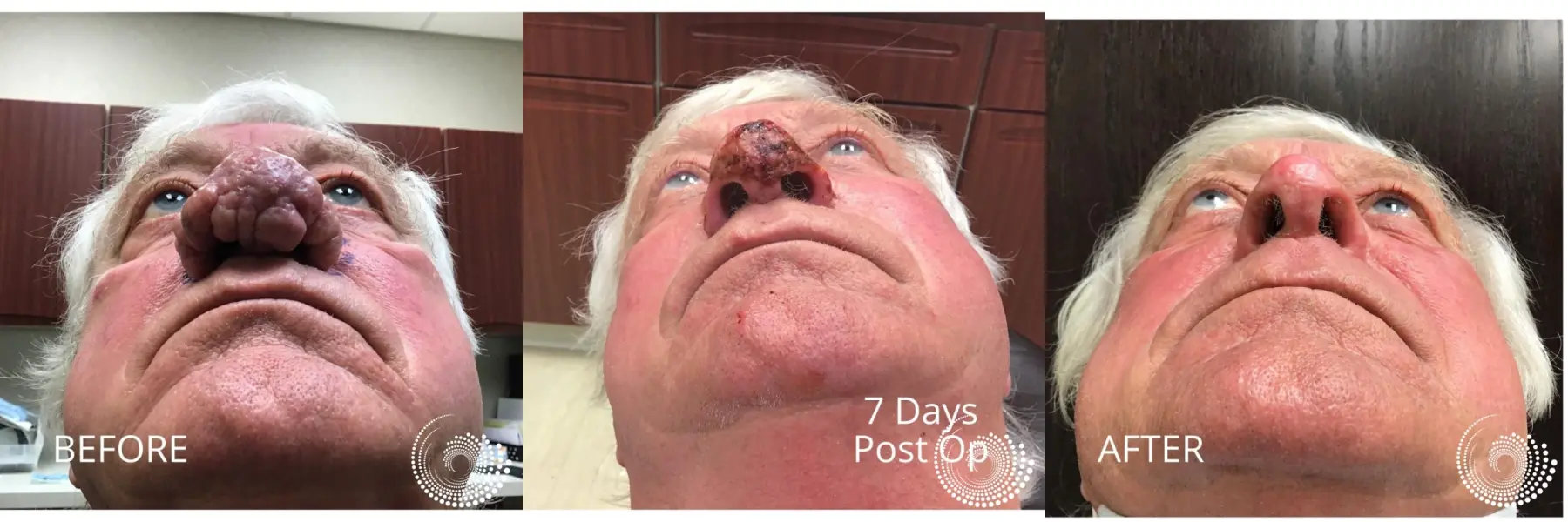 Rhinophyma clearance