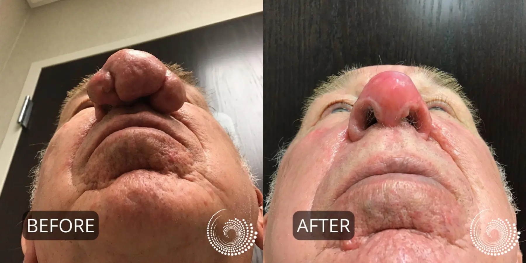 Rhinophyma treatment to reshape nose - Before and After 4