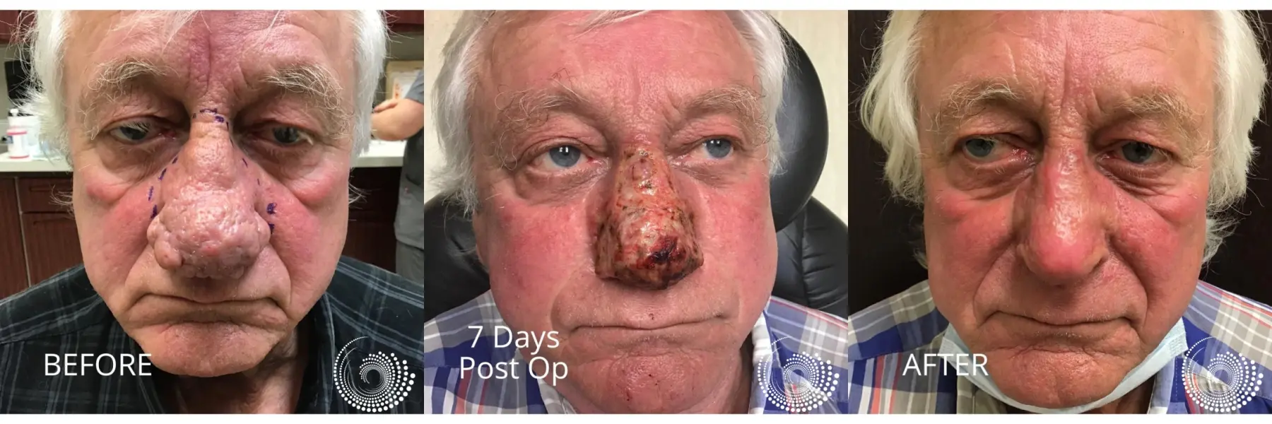 Rhinophyma treatment to restore nose - Before and After