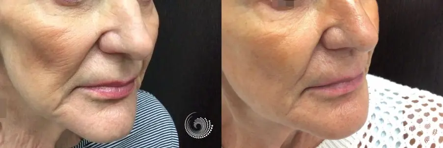 Sculptra Aesthetic: Patient 1 - Before and After  