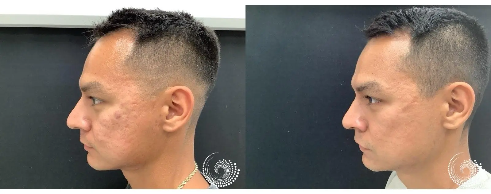 Smoother Skin & Renewed Confidence: SkinPen Microneedling Success Story - Before and After