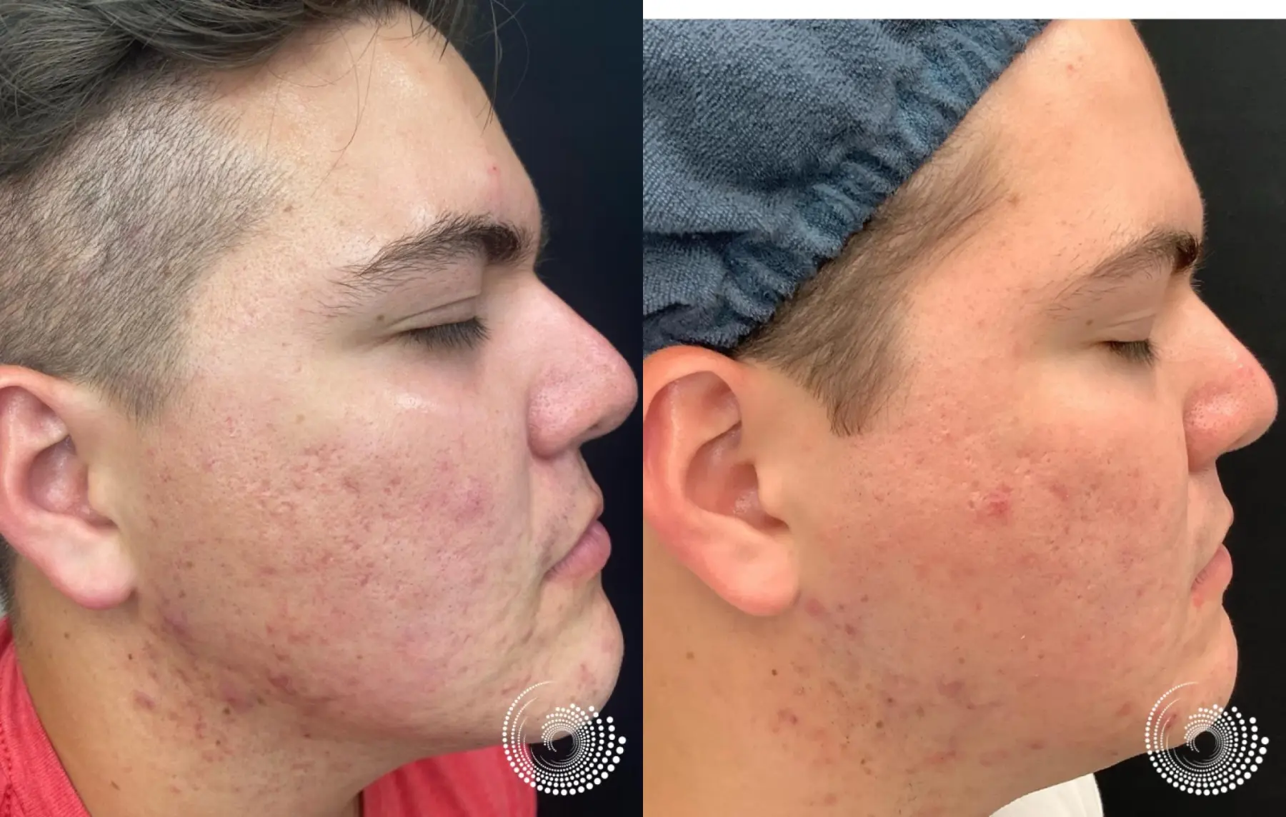 SkinPen Microneedling to smooth acne scars - Before and After 2