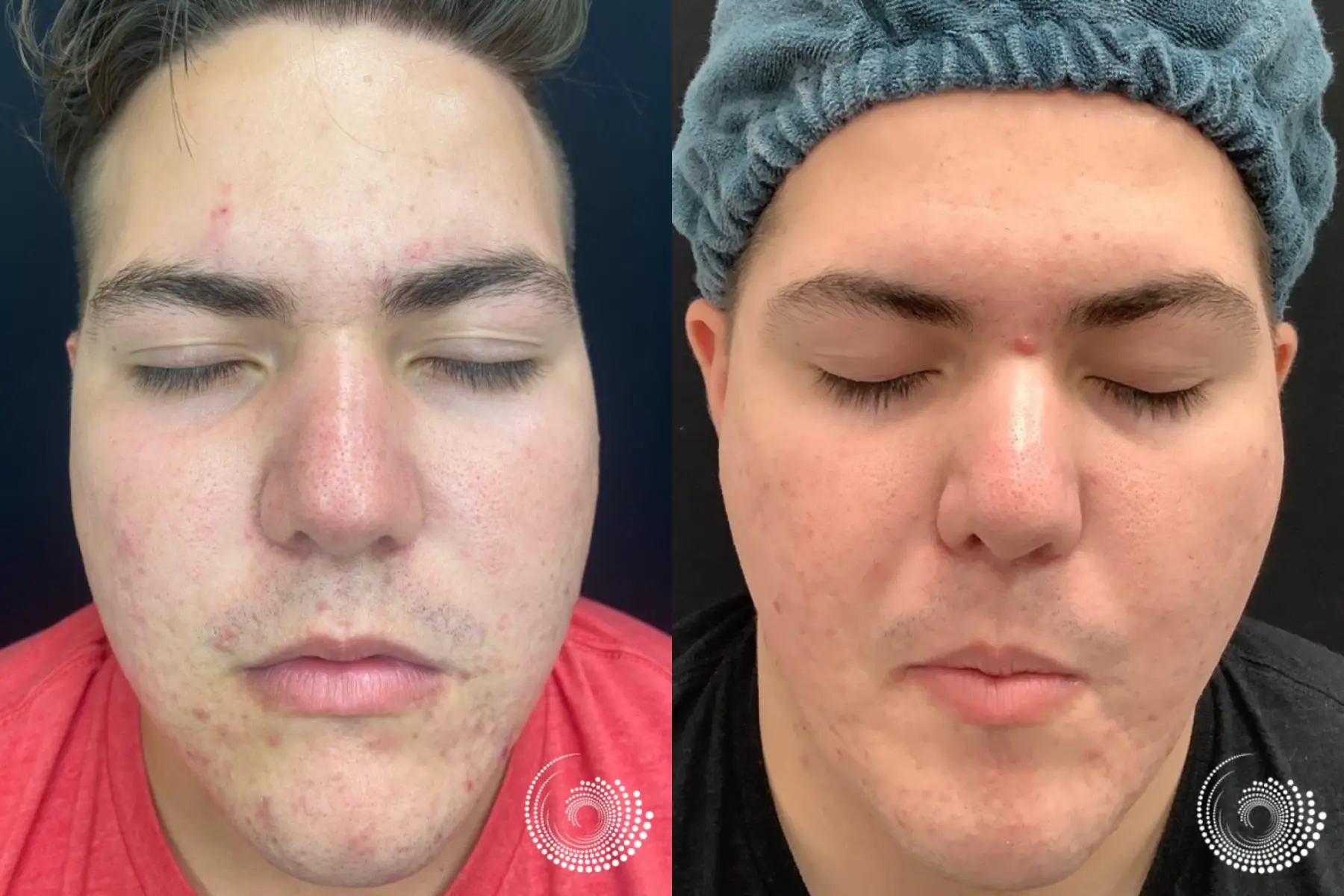 SkinPen Microneedling to smooth acne scars - Before and After