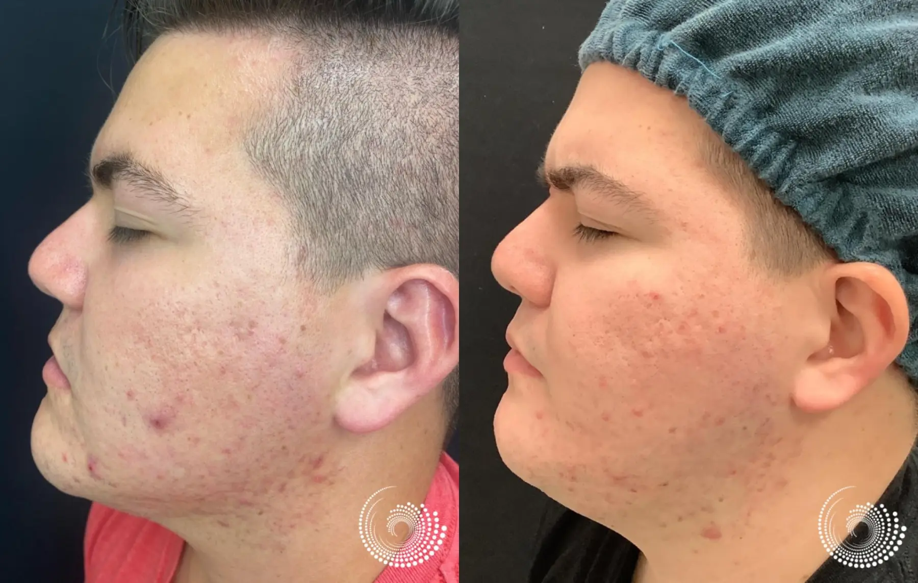 SkinPen Microneedling to smooth acne scars - Before and After 3