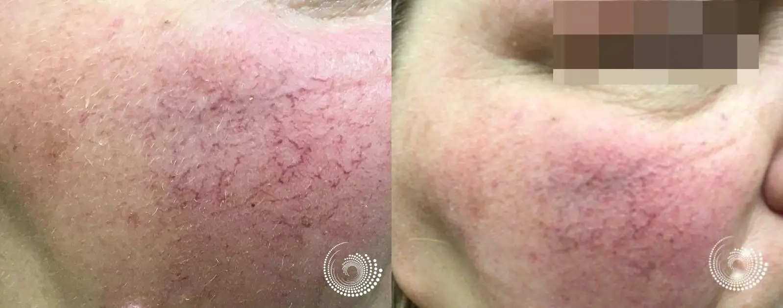 Spider Veins: Patient 1 - Before and After 2