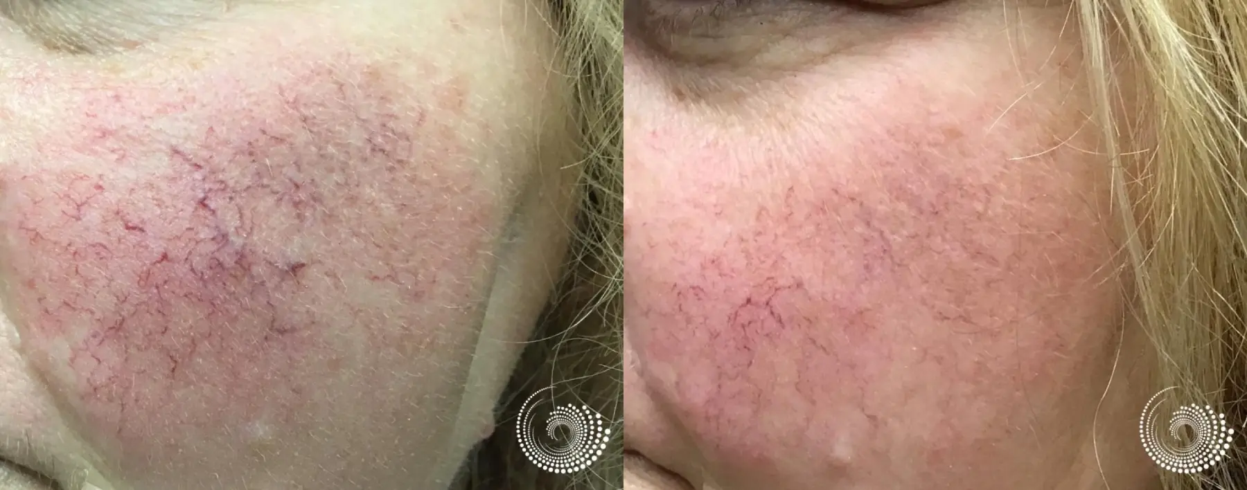 Spider vein,  telangiectasia, treatment on cheeks - before and after - Before and After