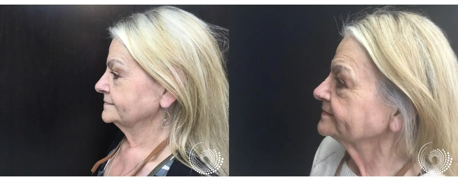 Ultra RF for Skin Laxity & Radiance - Before and After