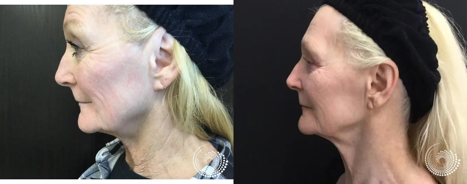 Ultra RF Tightens Skin & Rewinds Aging - Before and After