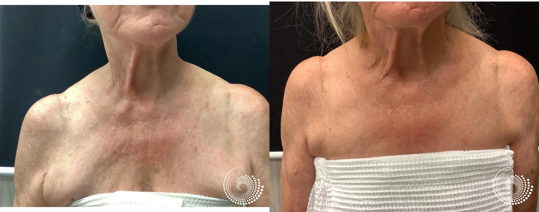 Ultra RF Rejuvenation for Chest, Face, & Neck - Before and After