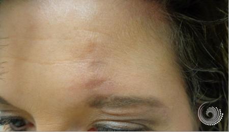 Basal Cell skin cancer, forehead near eyebrow - Mohs surgery -  After 3