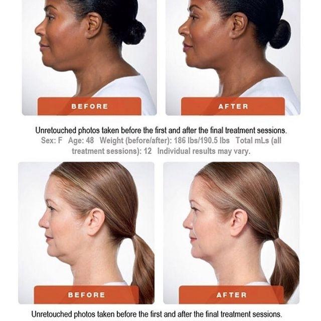 Kybella: Patient 1 - Before and After  