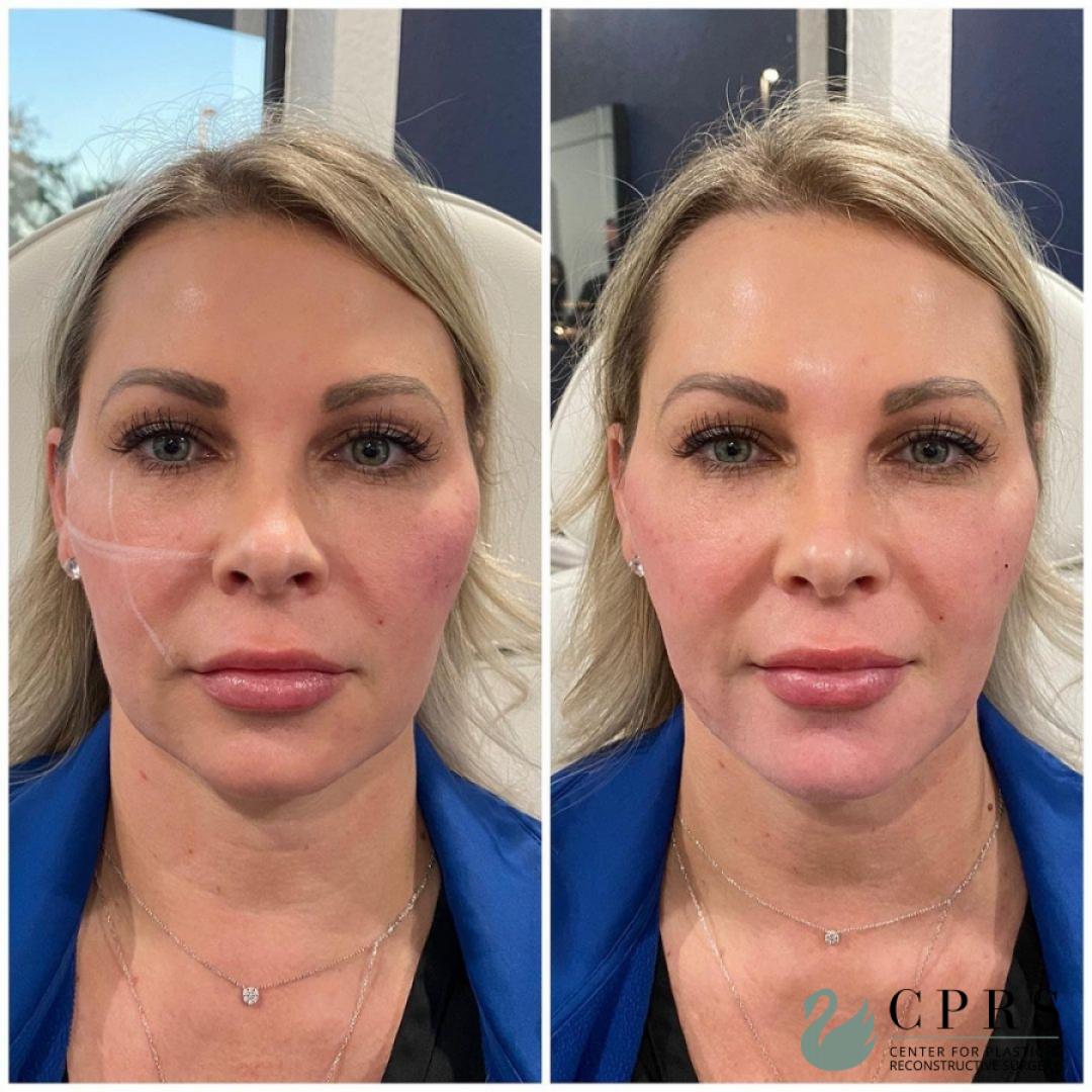 Fillers: Patient 6 - Before and After  