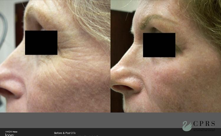 Laser: Patient 11 - Before and After 