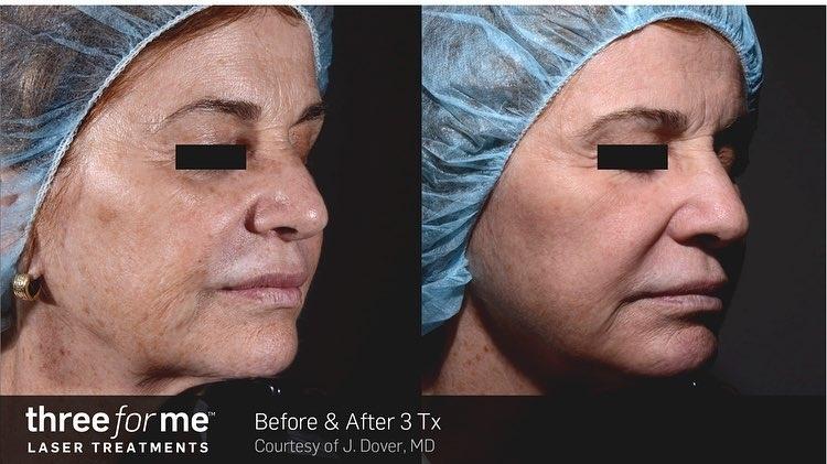 Laser: Patient 1 - Before and After  