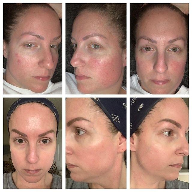 Laser: Patient 5 - Before and After  