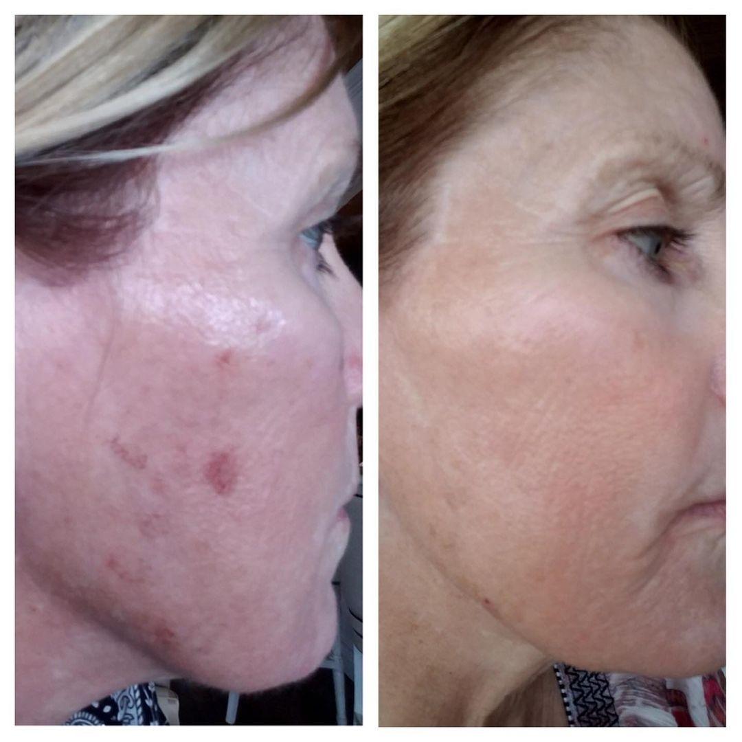 Laser: Patient 4 - Before and After  